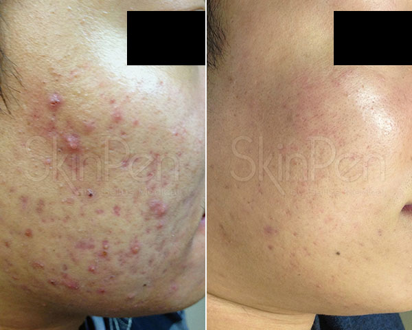 SkinPen før/efter