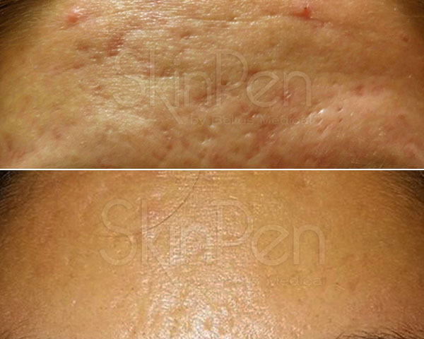 SkinPen før/efter