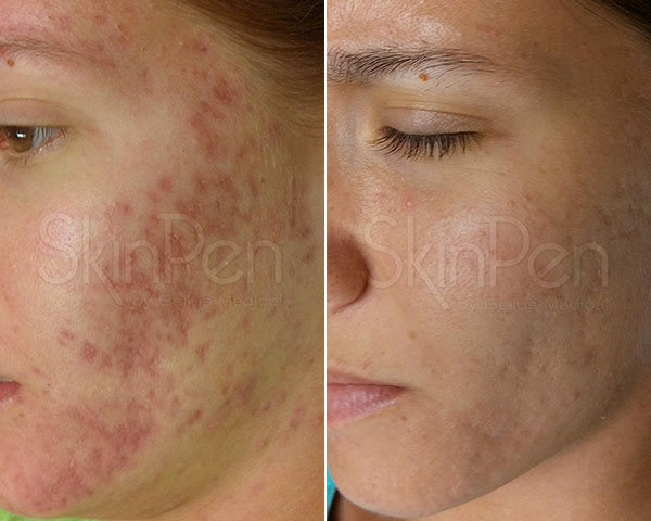 SkinPen før/efter