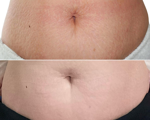 SkinPen før/efter
